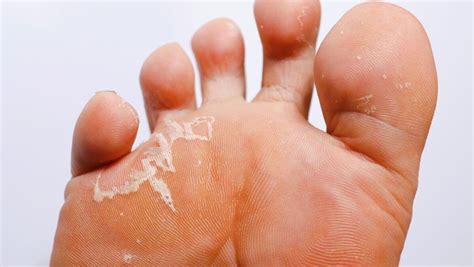 ayak altı deri soyulması tedavisi